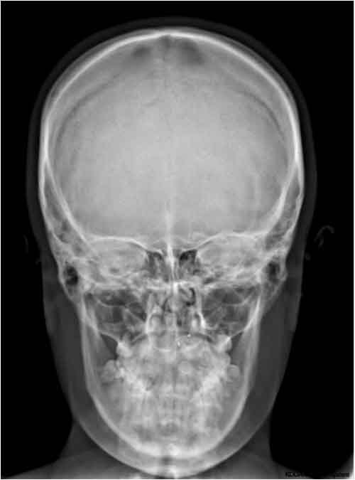 P.A. de Mandíbula - Unimagem Radiografia Odontológica Curitiba
