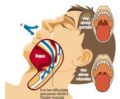 Ronco e apnéia do sono, aparelho oral é uma nova opção de tratamento.